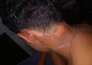 Adolescente joga água quente em menino após se incomodar com barulho