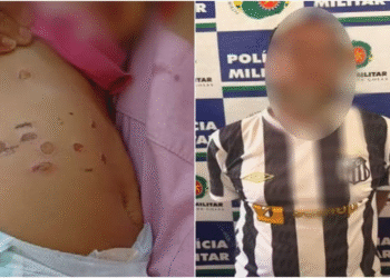 Padrasto é suspeito de queimar pé de bebê de 10 meses com cigarro
